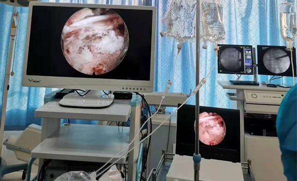 椎間孔鏡的基本配置有哪些？有哪些優(yōu)勢？